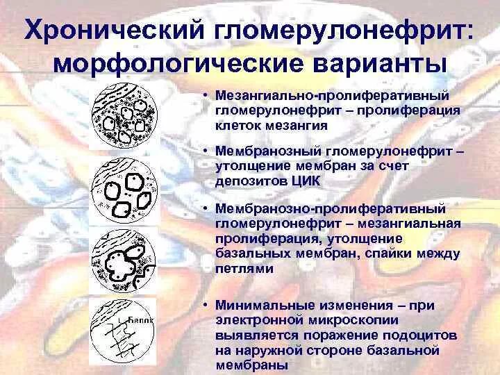 Гломерулонефрит какого типа. Мезангиально-пролиферативный гломерулонефрит. хронический гломерулонефрит классификация по морфологии. морфологические формы хронического гломерулонефрита. морфология гломерулонефрита.