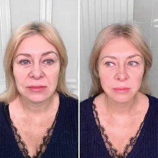 Коллаген уколы для лица