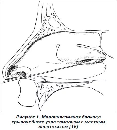 Блокада с дексаметазоном. Новокаиновая блокада при рините. Эндоназальная блокада носа. Эндоназальные новокаиновые блокады.