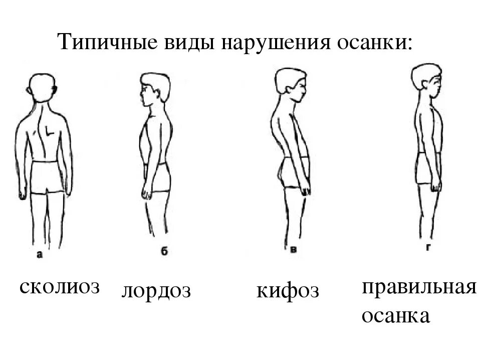 Как называется осанка выраженная в позе прямостояния