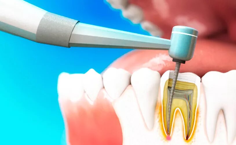 Восстановление после эндодонтического лечения. Эндодонтическое перелечивание зубов. Что такое периодонтит в стоматологии. Стоматология рентген периодонтит.