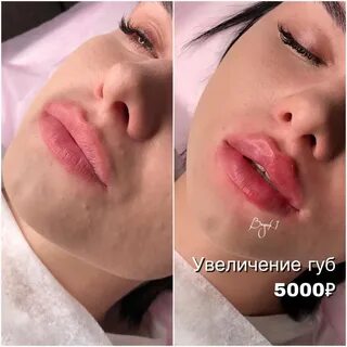 Корейский филлер для увеличения губ