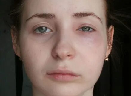 Что делать если один глаз больше другого
