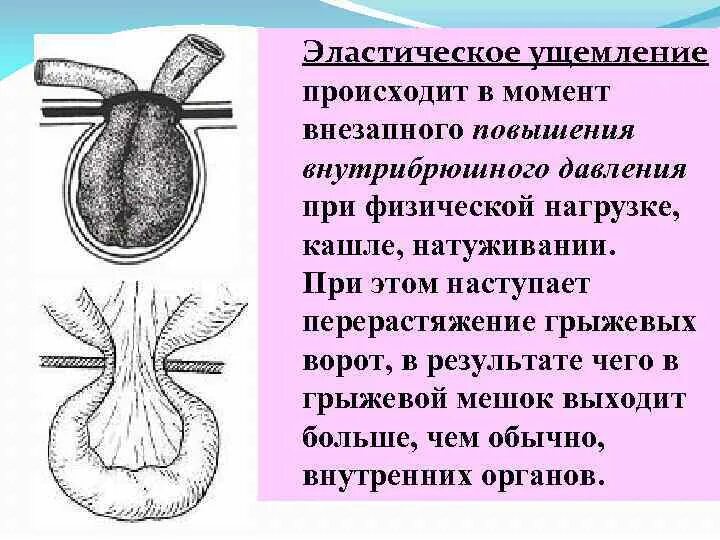 Ответы ущемленная грыжа. Клинические проявления ущемленной грыжи. Эластическое ущемление грыж живота. Эластическое ущемление грыжи. Ущемленная пупочная грыжа.