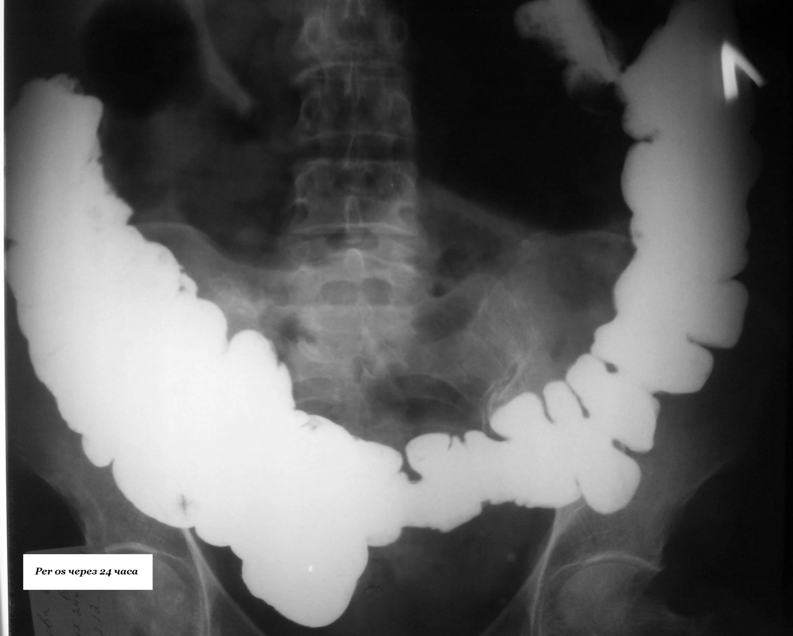 Инвагинация Толстого кишечника рентген. Спаечная болезнь кишечника рентген. Кишечная непроходимость толстокишечная рентген. Динамическая кишечная непроходимость рентген. Парез кишечника операция