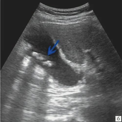 Акустические тени в почках. Гиперэхогенные желчном пузыре. Полип желчного пузыря на УЗИ. Множественные конкременты желчного пузыря.