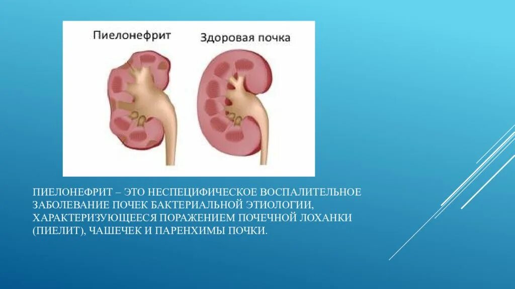 Пиелит воспаление почечной лоханки. Профилактика пиелита, пиелонефрита. Пиелит это