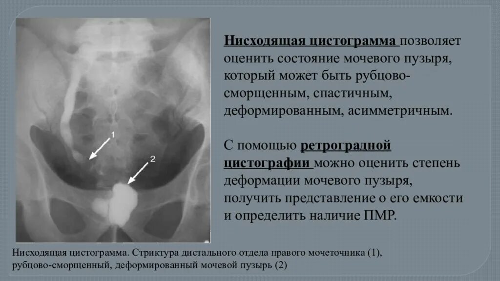 Утолщение мочевого пузыря у мужчин. Микционная цистография мочевого пузыря. Цистография мочевого пузыря рентген описание. Нисходящая цистография. Цистография нисходящая и восходящая.