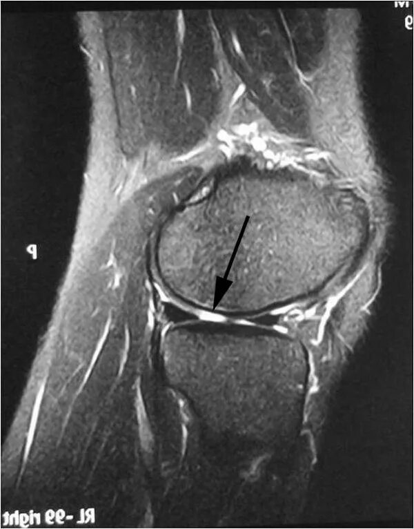 Снимок мрт коленного сустава с разрывом мениска. Мрт коленного сустава разрыв мениска. Травма мениска коленного сустава мрт. Снимок мрт разрыв мениска.