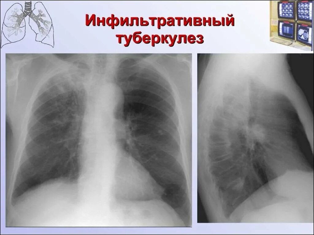 Очаговое поражение легких. Инфильтративный туберкулез рентгенография. Инфильтративный туберкулез рентген. Инфильтративный туберкулез легких рентген. Инфильтративная форма туберкулеза рентген.