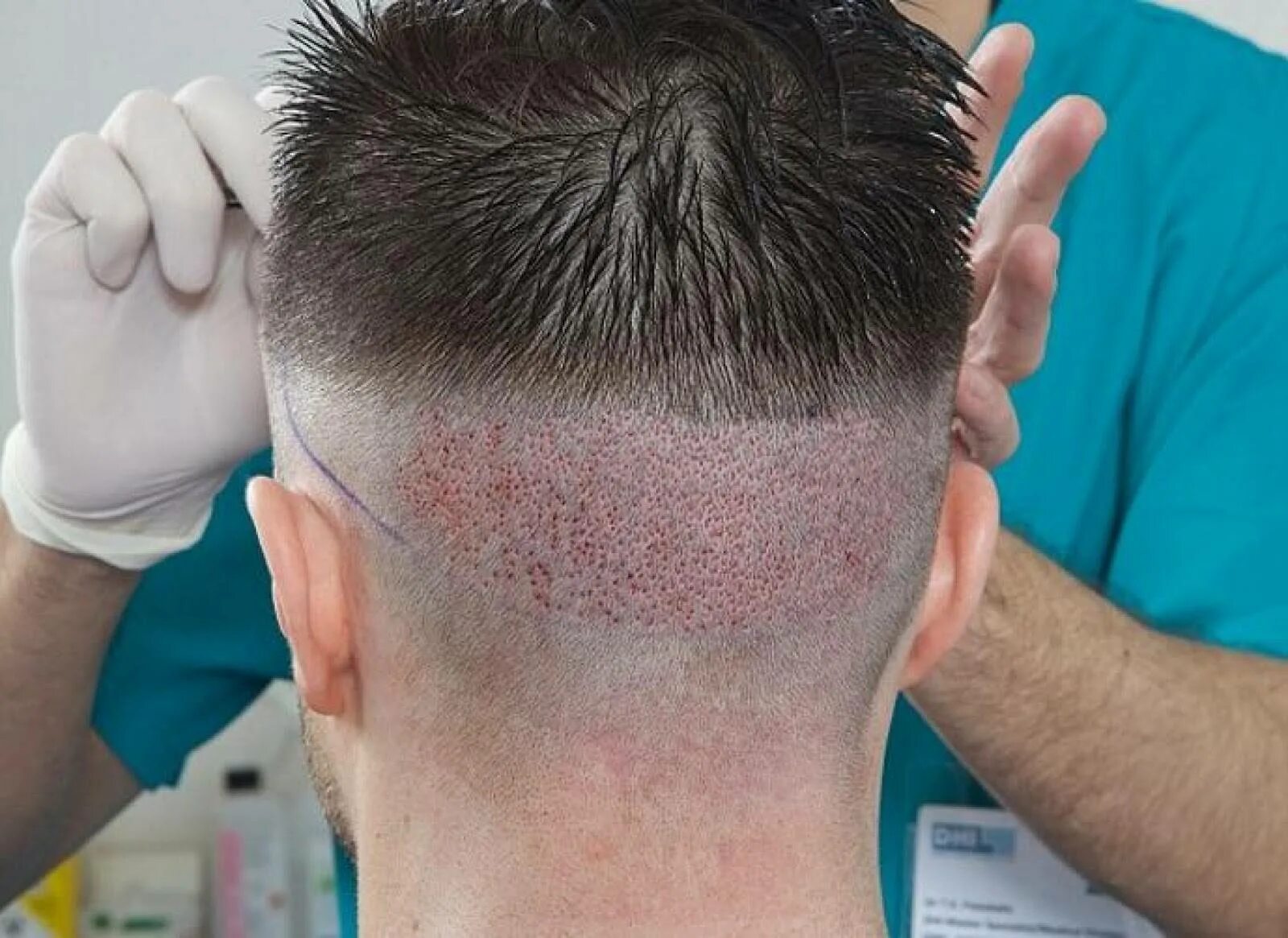 Пересадка волос донорская зона. Трансплантация волос на голове. Мужская трансплантация волос.