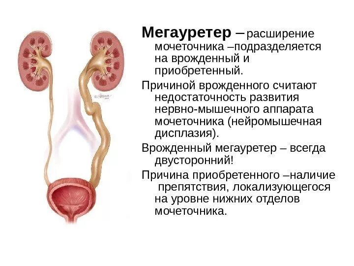 Дилатация мочеточника. Врожденное расширение мочеточника [врожденный мегалоуретер]. Нейромышечная дисплазия мочеточника. Нервно мышечная дисплазия мочеточника. Рефлюксирующий мегауретер.