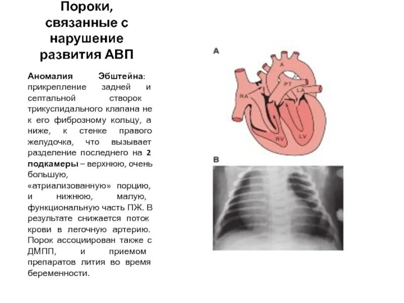 Аномалия эбштейна гемодинамика. Аномалия эбштейна клинические рекомендации. Аномалия эбштейна сердца врожденный порок. Аномалия эбштейна клинические рекомендации. Аномалия эбштейна сердца врожденный порок сердца.