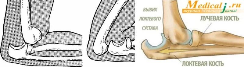 Подвывих локтевого сустава у ребенка. Вывих со смещением в локтевом суставе. вывих локтевого сустава гипс.