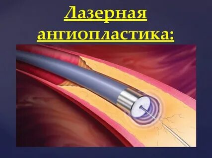 Лазер 21