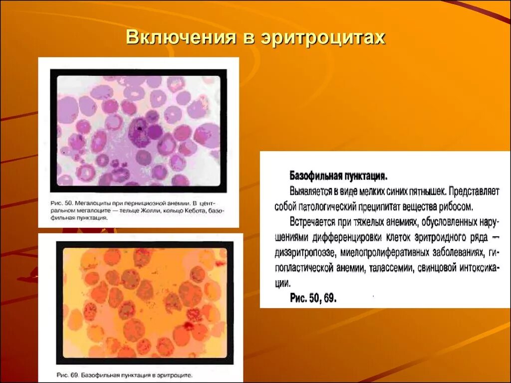 Базофильная зернистость эритроцитов; тельца Гейнца. Включения в эритроцитах тельца Жолли. Базофильная пунктация при апластической анемии. В эритроцитах кольца Кебота тельца Жолли. Тельце гейнца