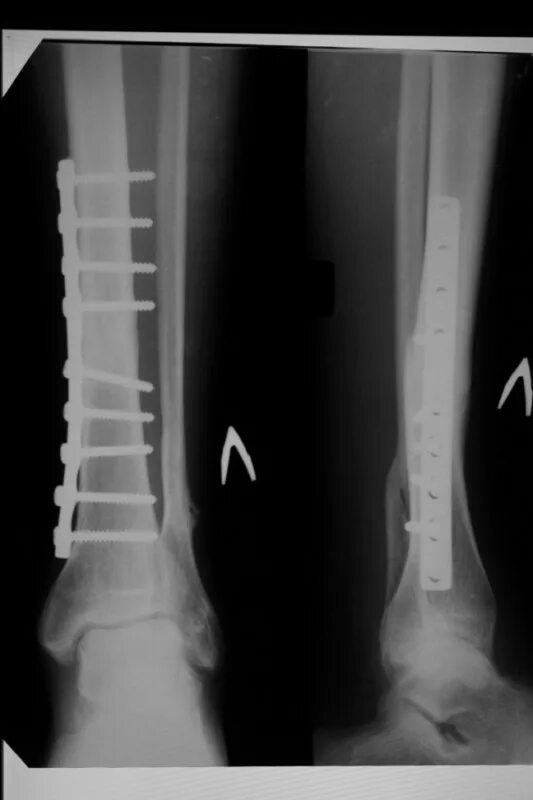 перелом лодыжки с остеосинтезом. корригирующая остеотомия коленного сустава. чрескостный остеосинтез лодыжки. пластина на берцовую кость операция. пластина на берцовую кость операция.