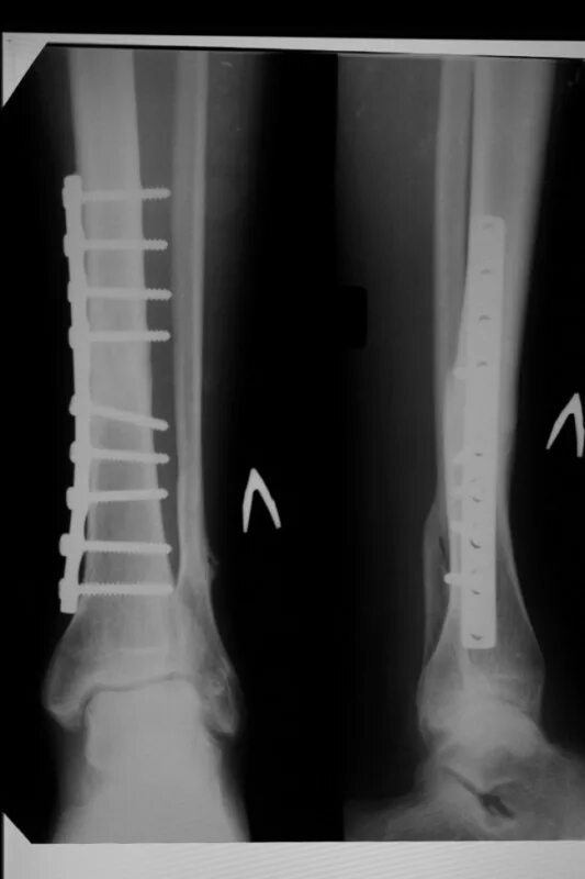 Перелом большеберцовой кости остеосинтез. Перелом н/3 малоберцовой кости. Остеосинтез костей голени. Операция малоберцовой кости