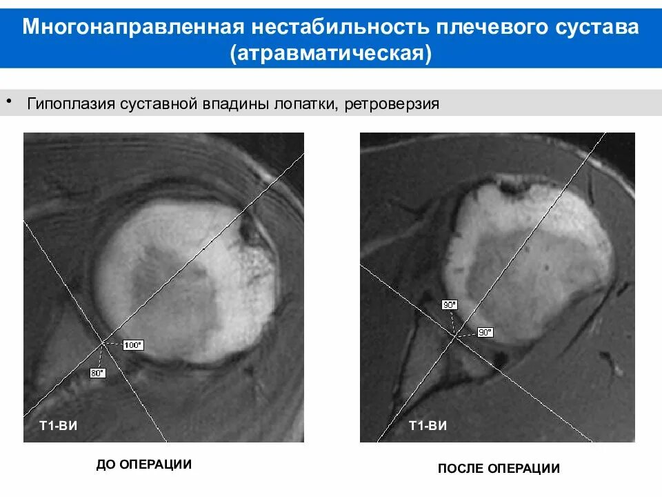 Нестабильность плечевого сустава мкб. Нестабильность плечевого сустава мрт. многонаправленная нестабильность плечевого сустава. передняя нестабильность плечевого сустава мрт. гипоплазия суставной впадины лопатки.