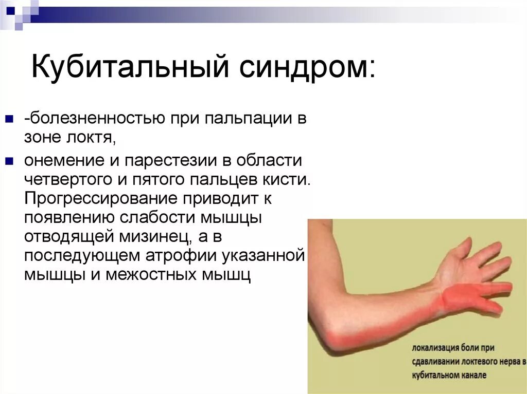 Невропатия локтевого мкб. Туннельный синдром локтевого нерва. Невропатия локтевого нерва туннельный синдром. Кубитальный синдром локтевого нерва. Кубитальный туннельный синдром локтевого нерва.