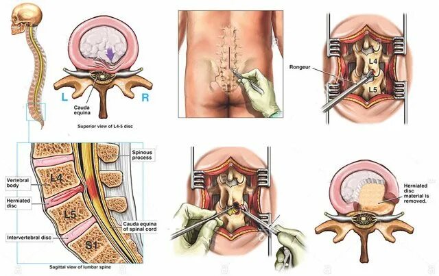 Сколько реабилитация после удаления грыжи. Дискэктомия поясничного отдела позвоночника l5-s1. Микродискэктомия поясничного отдела l5-s1. Операция грыжи позвоночника l5 s1. Микродискэктомия поясничного отдела позвоночника l5-s1.