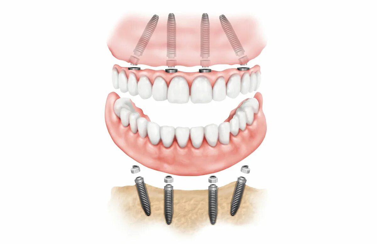 Технология имплантации зубов all-on-4.