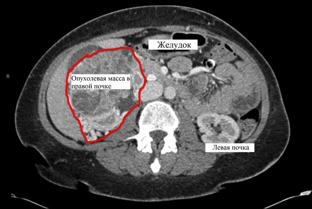 Мультиспиральная кт почек опухоль. На кт видно опухоль