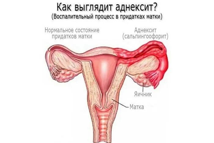 сальпингит лапароскопия. маточные трубы это придатки. хронический сальпингоофорит. гонорейный сальпингит. левый придаток матки.