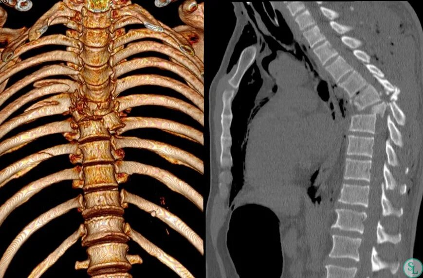 Повреждения позвоночника переломы. Кт (МСКТ) грудного отдела позвоночника. РКТ грудного отдела позвоночника. Снимок РКТ позвоночника. Компьютерная томография грудного отдела позвоночника.