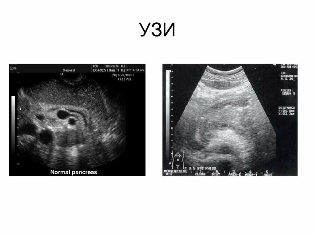 Сонограмма поджелудочной железы. Поджелудочная железа УЗИ при патологии. Хронический панкреатит УЗИ. Сонография поджелудочной железы.