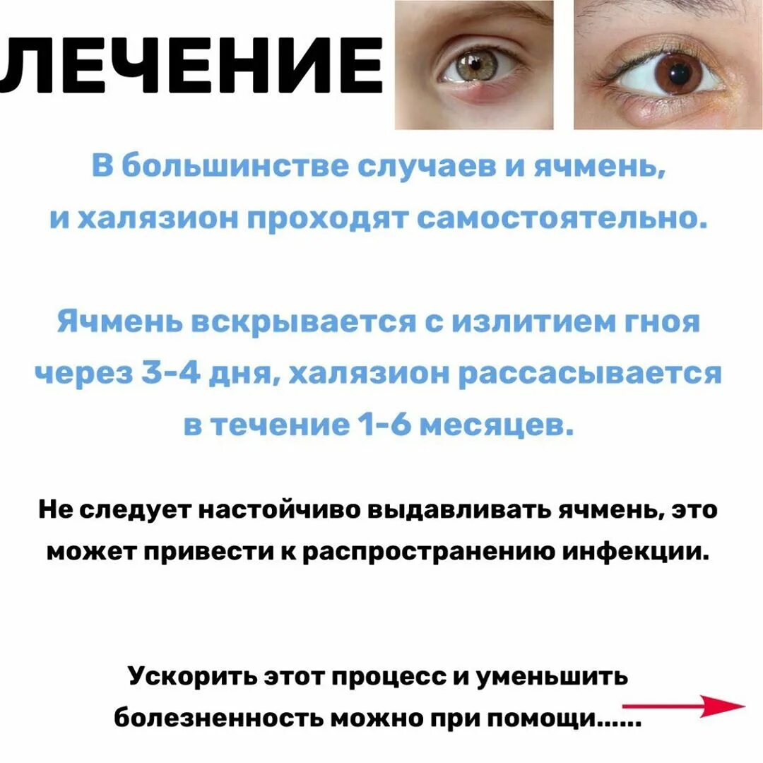 Через сколько появляется отзыв. Воспаление глаза ячмень. Ячмень на глазу стадии развития.