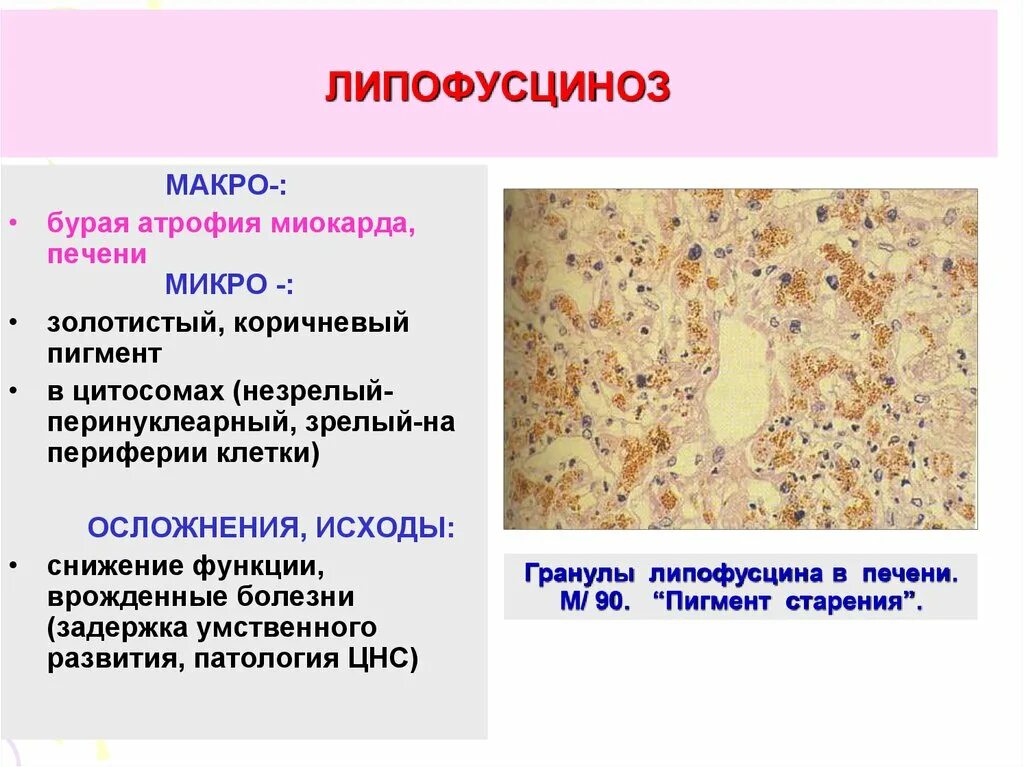 Изменение клеток печени. Бурая атрофия печени макропрепарат описание. Бурая атрофия печени патанатомия. Бурая атрофия печени микропрепарат. Липофусциноз патанатомия.