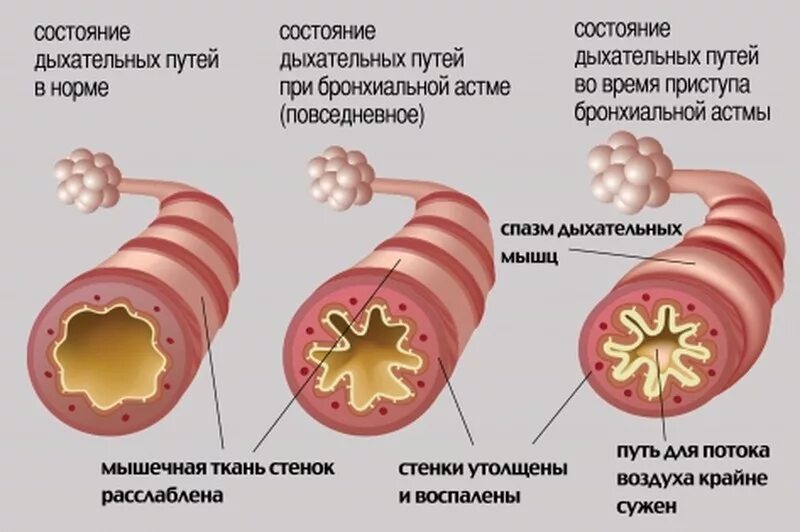 Как снять бронхоспазм без Бронхоспазм у взрослых и детей: симптомы и лечение. Чем снять бронхоспазм