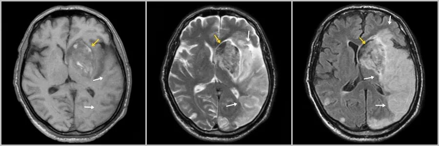 Мрт снимки. Распечатать снимки мрт. Мрт мозга норма здорового человека. Снимок мрт здорового человека. Мрт снимок.