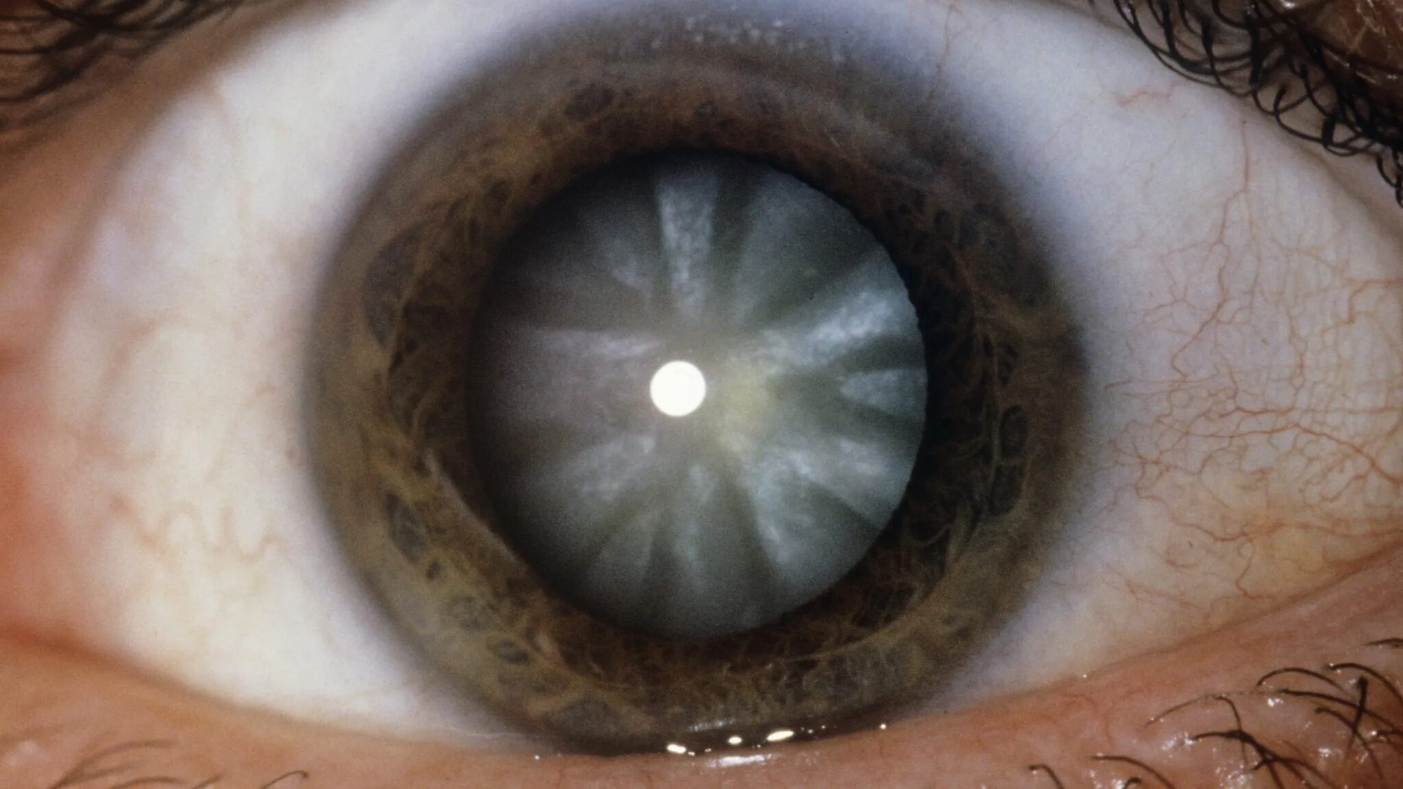 Когда после замены хрусталика восстанавливается зрение глаза. Пресенильная катаракта. Контузионная катаракта. Кортикальная катаракта.