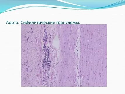 Сифилитический мезаортит