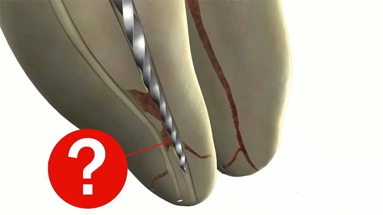 Степ бэк обработка корневых каналов. Эндодонтия crown down. Эндодонтия crown down. Техника краун даун. Эндодонтия crown down.