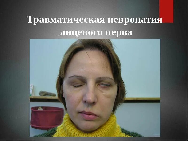 Повреждение нервов лица