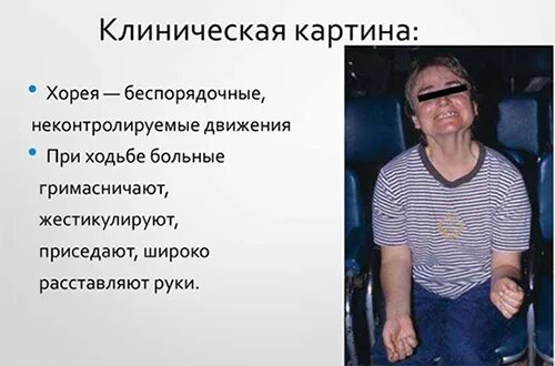 Болезнь пляска святого. Синдром Хорея Гентингтона симптомы. Болезнь Хантингтона (Хорея Гентингтона). Хорея Гентингтона психиатрия. Ювенильная Хорея Хантингтона.