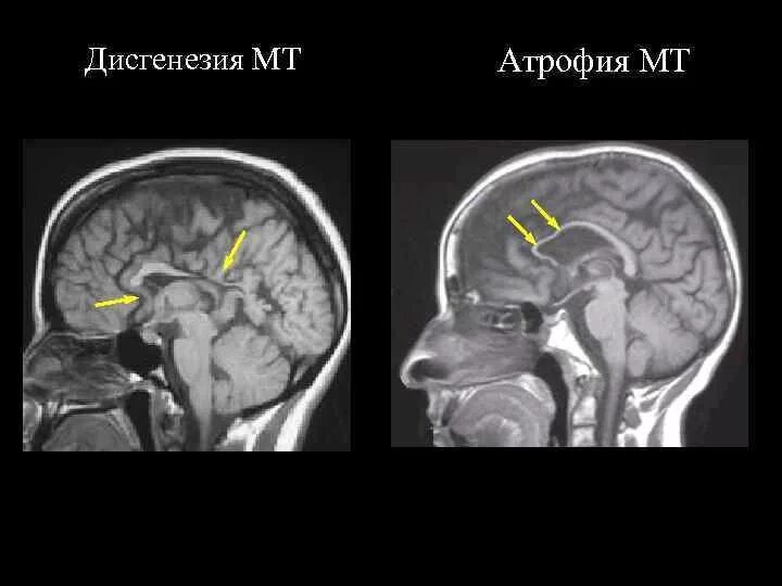 Мозолистое тело анатомия мрт. Анатомия мозолистого тела головного мозга мрт. Мозолистое тело на кт анатомия. Атрофия головного мозга на кт. Диффузная церебральная