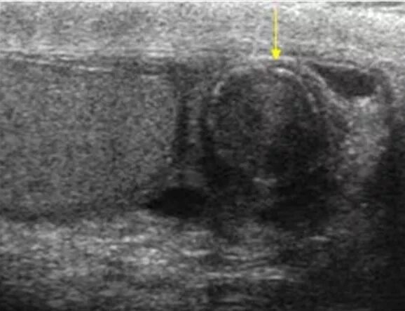 Образование придатка яичка. Олеогранулемы молочной железы на УЗИ. Перекрут яичка УЗИ картина. Гранулема послеоперационного рубца на УЗИ. Диафаноскопия перекрут яичка.