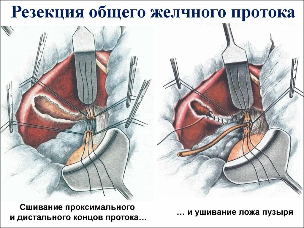 Операция резекция печени. Резекция печени топографическая анатомия. Резекция печени операция. Ушивание печени операция. Операции на печени топографическая анатомия.