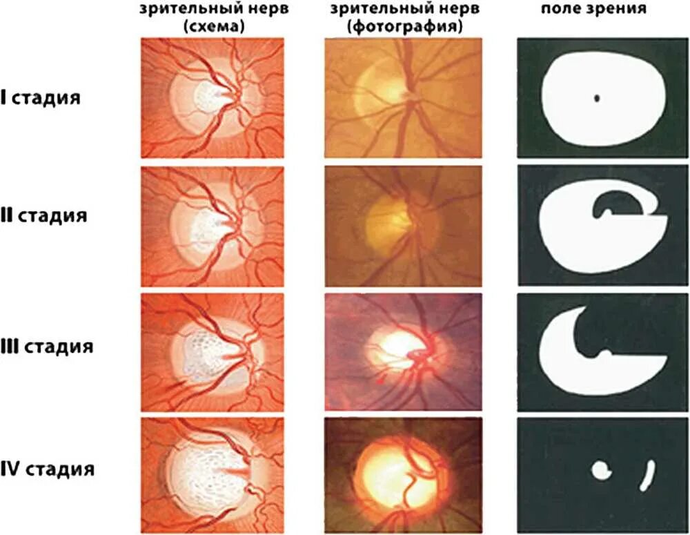 Атрофия зрительного нерва Лебера. Атрофия зрительного нерва классификация. Атрофия зрительного нерва Лебера этиология. Открытоугольная глаукома глазное дно.