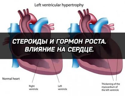 Спор на сердце