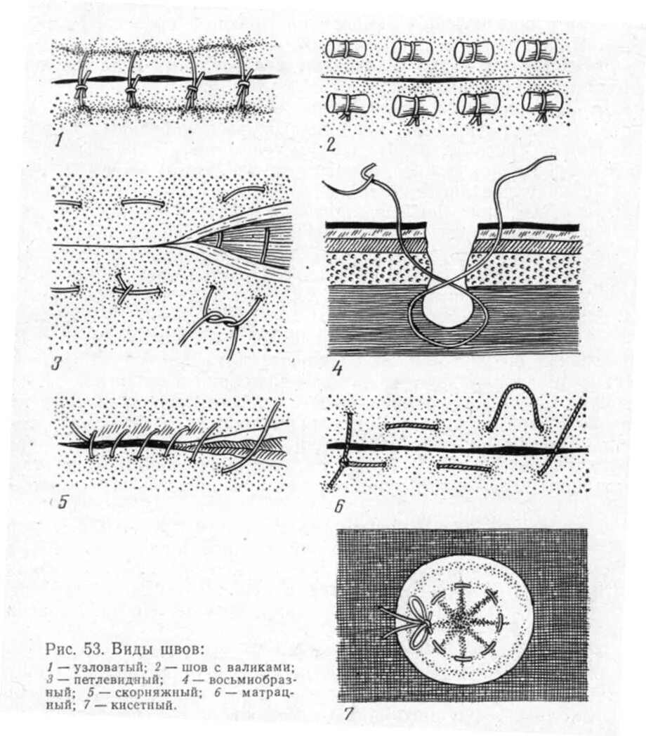 Наложение хирургических швов Ветеринария. Хирургические швы в ветеринарии классификация. Петлевидный шов техника наложения. Петлевидный хирургический шов. Как называется шов после операции