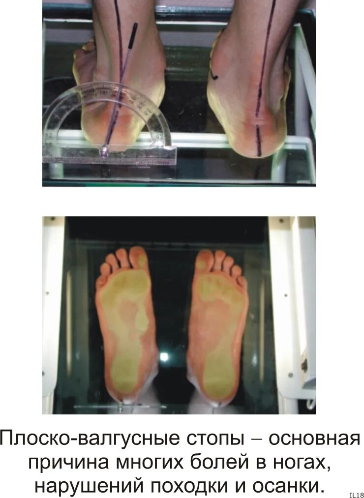 Вальгусная стопа операция цена. Поперечное плоскостопие вальгус. Плоскостопие вальгусная стопа. Вальгус вальгус плоскостопие. Плоскостопие вальгус степени.