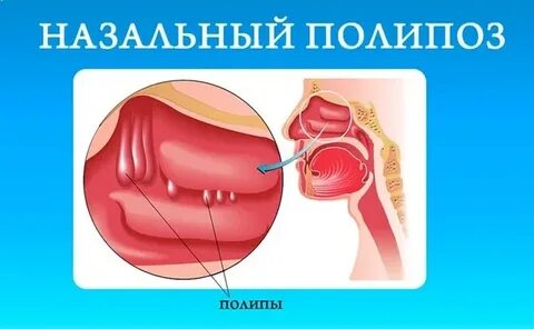 Почему сохнет в носу и образуются