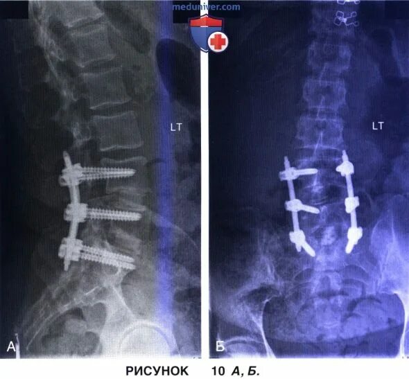 Последствия блокады позвоночника. Задний спондилодез l5-s1. Задний спондилодез l5 l6. Атлантоаксиальный спондилодез аномалия. Задний спондилодез поясничного отдела l3-l5.