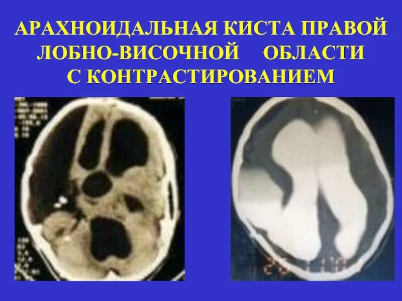 Височная киста головного мозга. Арахноидальная киста сильвиевой щели. Арахноидальная киста правой лобной. Арахноидальная киста правой лобной доли. Арахноидальная киста правой височной области.