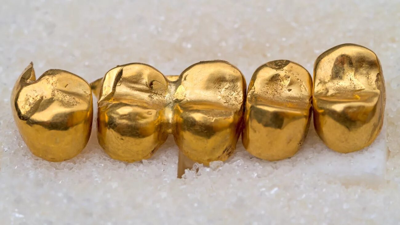 Сколько стоит металлические зубы. Коронки 850 проба золотые. Золотые коронки 750 пробы. Золотая штампованная коронка 900 пробы. Сплав золота 750 пробы в стоматологии.